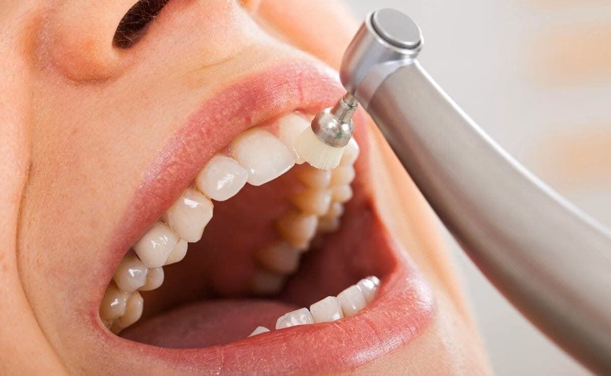 ¿Cuánto cuesta una limpieza profunda en la boca?